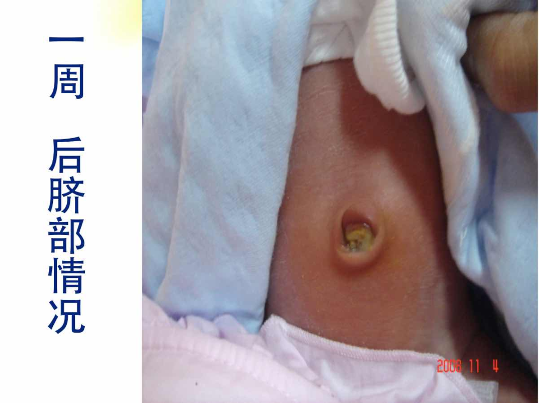 新生儿脐部正确护理, 脐带未脱落和脱落后的不同护理方法